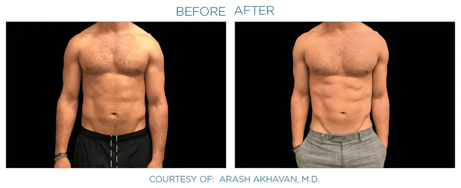 Emsculpt Neo effect on abdomen
