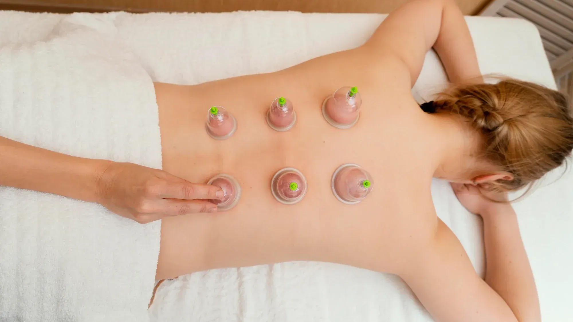Patient receiving cupping therapy treatment at Bensa Chiropractic and Wellness in Bradenton FL